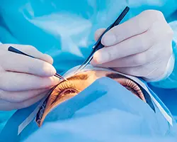 Glaucoma Surgeries