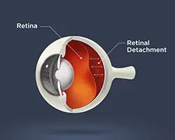 Retinal Detachment