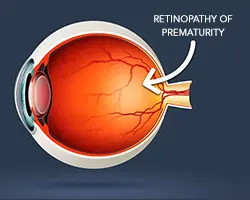 Retinopathy of Prematurity