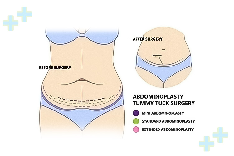 Post-abdominoplasty (tummy tuck) surgery results.