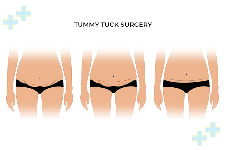 Abdominoplasty (tummy tuck) surgery in progress.