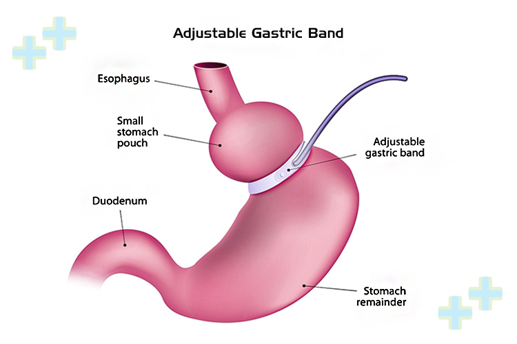 Adjustable gastric banding surgery illustration.