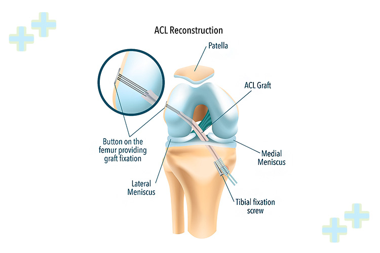 Additional view of arthroscopic ACL reconstruction surgery.