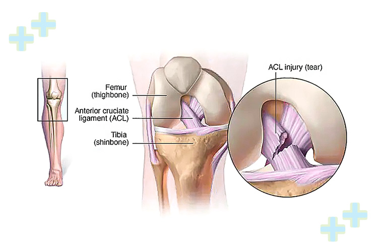 Arthroscopic ACL reconstruction surgery image.