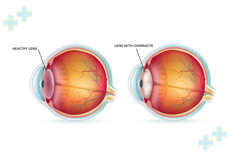 Femto laser-assisted cataract surgery procedure in action.