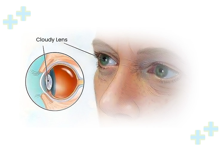 Detailed view of femto laser-assisted cataract surgery.