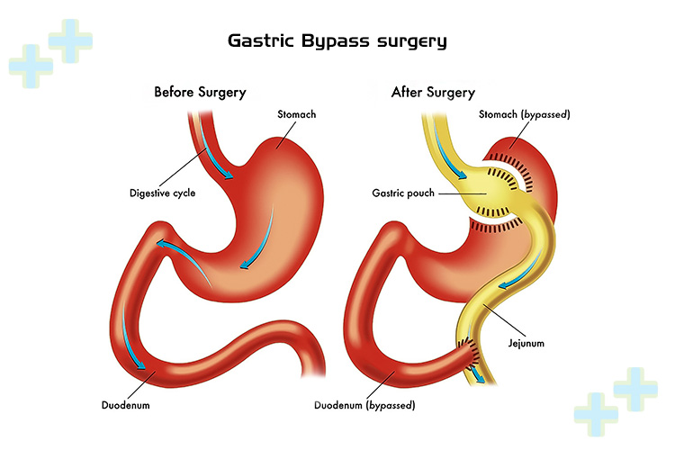 Gastric bypass surgery procedure with Health Trawell branding.