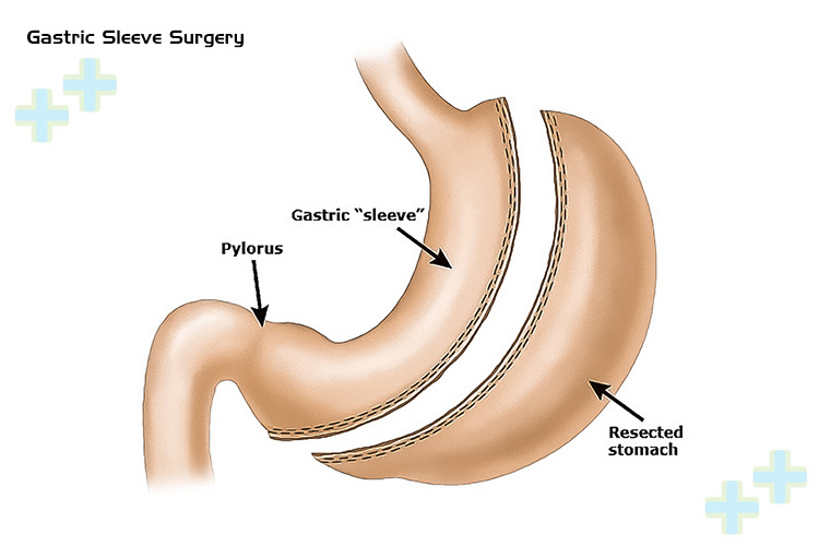 Gastric sleeve surgery illustration.