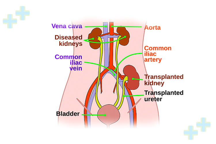 Surgeons performing a kidney transplant operation