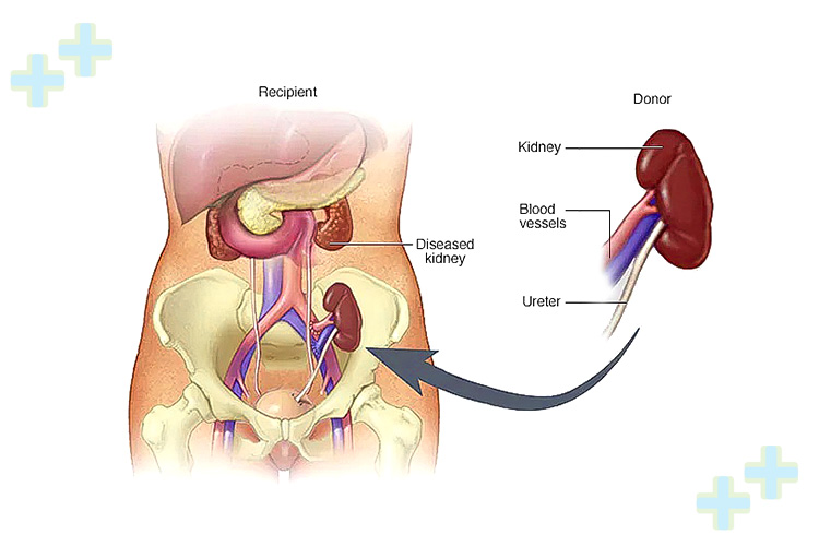 Kidney transplant surgery with surgeons and medical equipment.