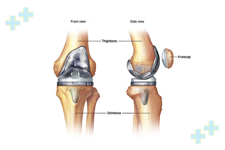 X-ray image showing knee joint before and after replacement.