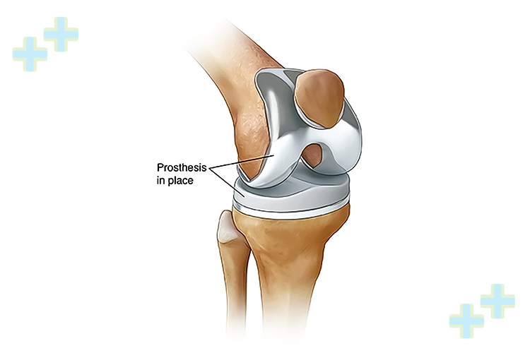 Patient undergoing knee replacement surgery with medical staff.