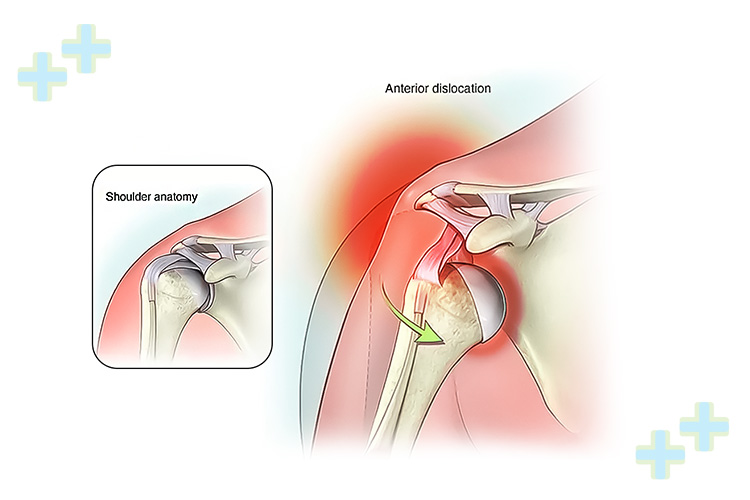 Shoulder dislocation treatment in progress.