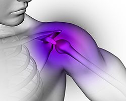 Shoulder dislocation treatment illustration.