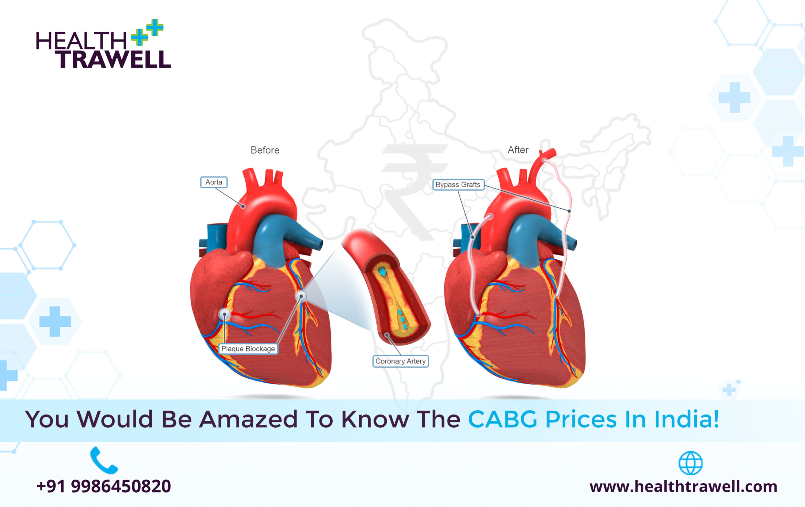 CABG Prices in India