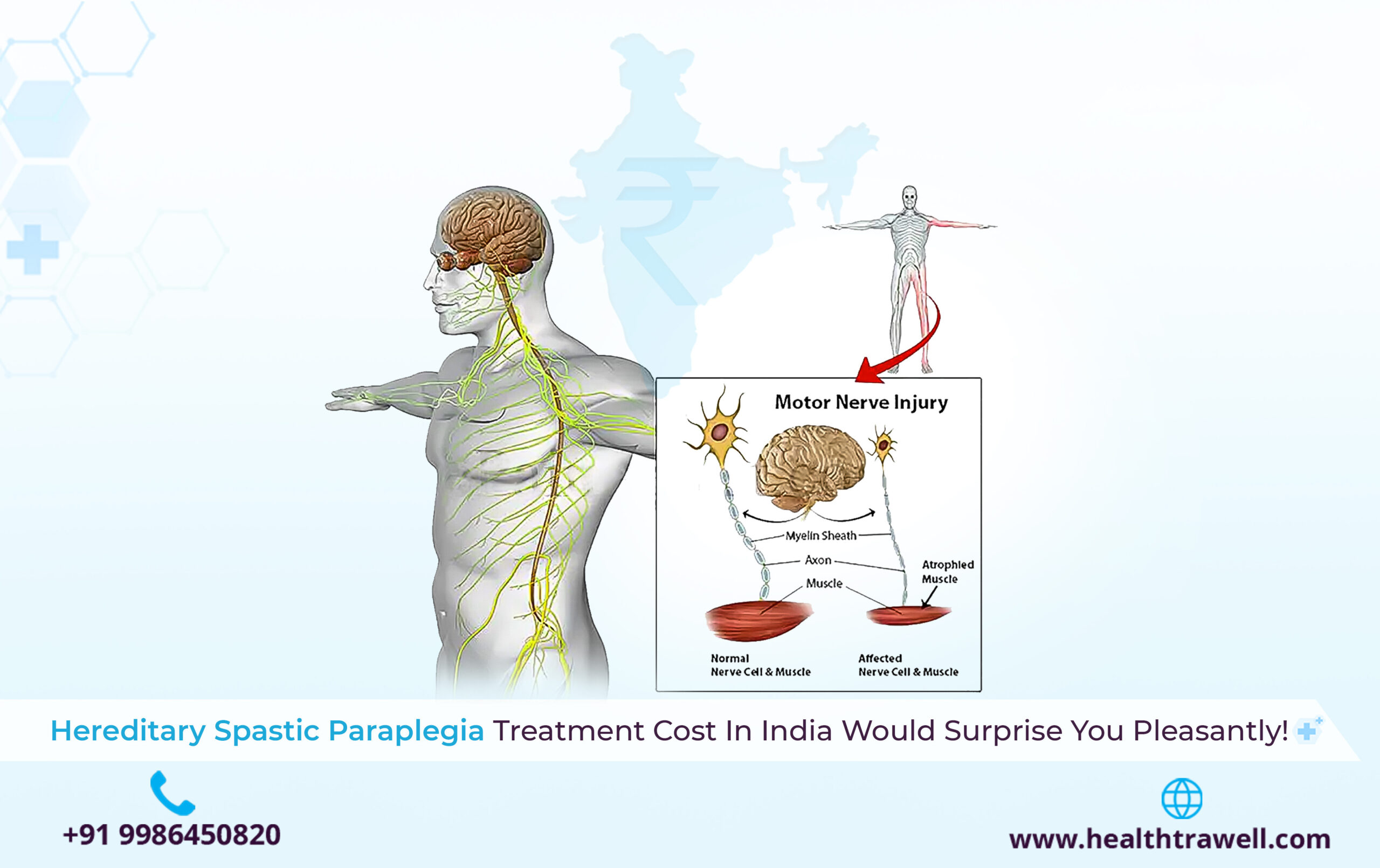 Hereditary Spastic Paraplegia Treatment Cost in India