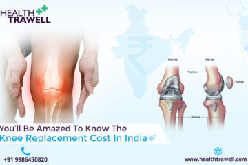 Knee Replacement Cost in India