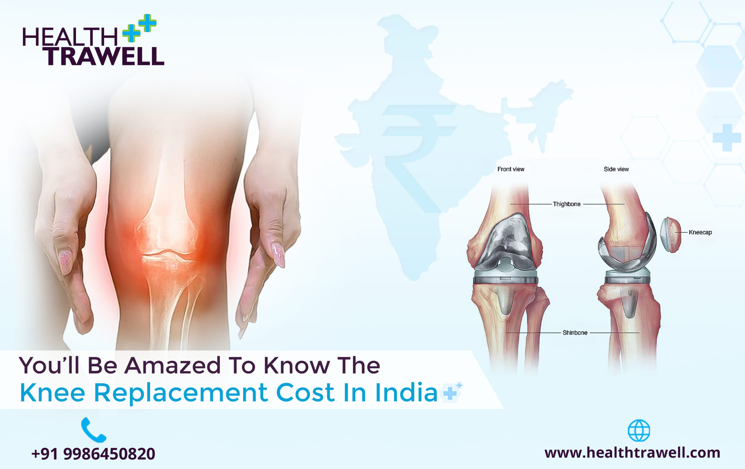 Knee Replacement Cost in India