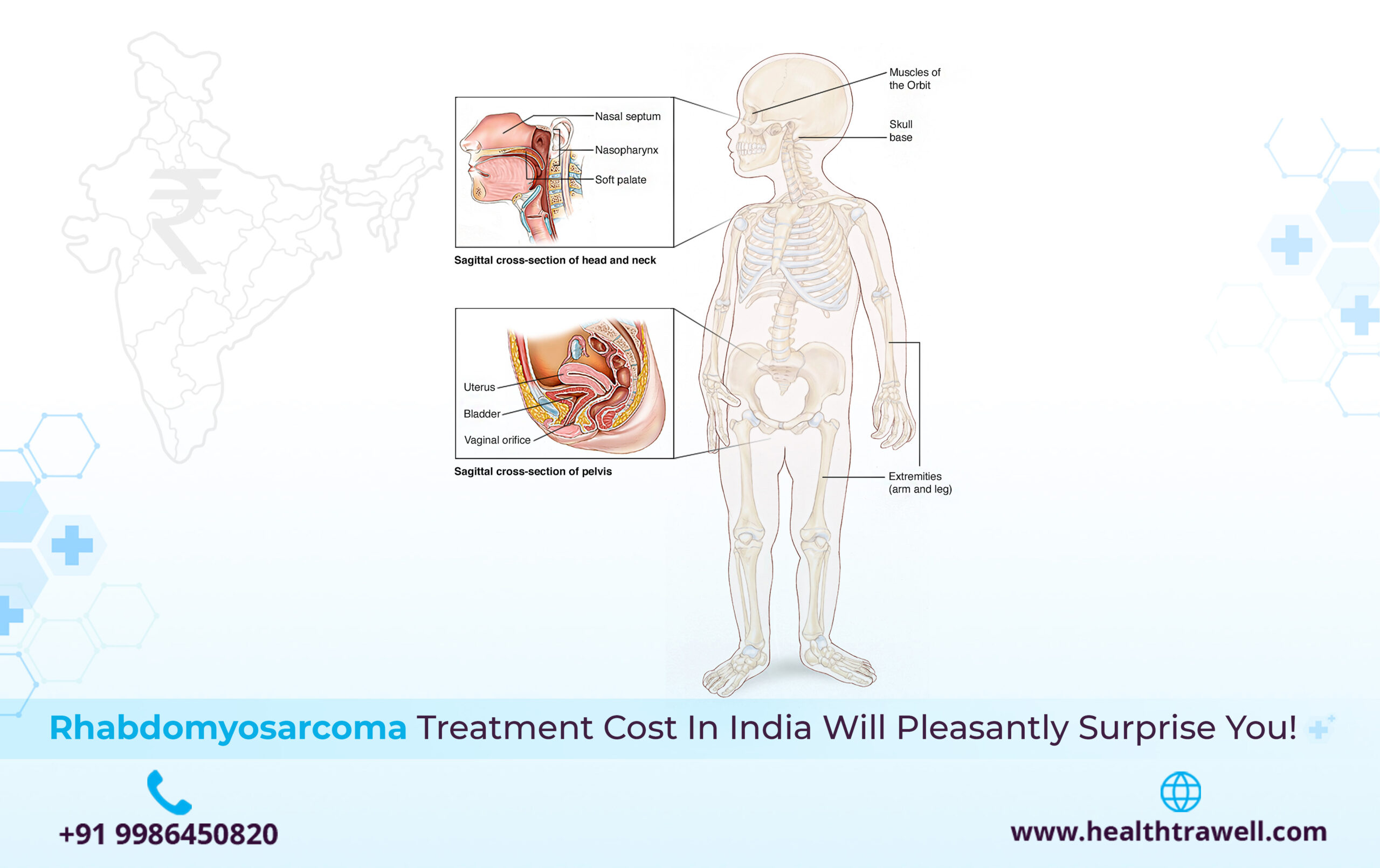 Rhabdomyosarcoma Treatment Cost