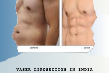 A person showcasing their sculpted body after VASER Liposuction.